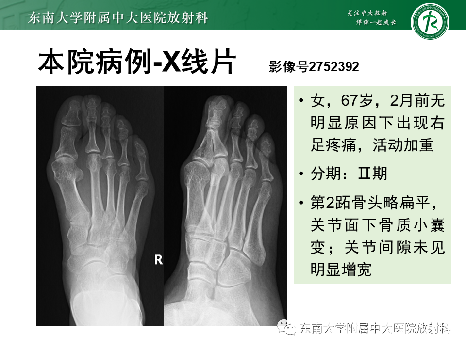 影像PPT - 【PPT】Freiberg病（跖骨头缺血性坏死）-32