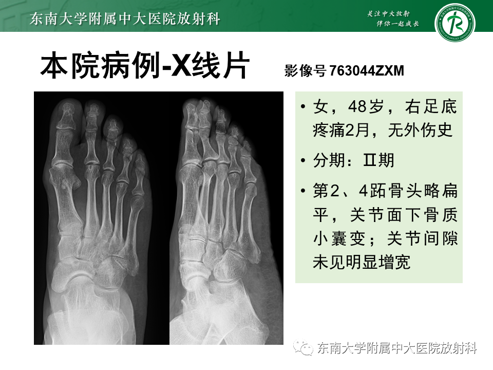 影像PPT - 【PPT】Freiberg病（跖骨头缺血性坏死）-33