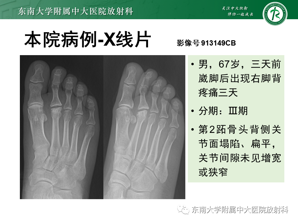 影像PPT - 【PPT】Freiberg病（跖骨头缺血性坏死）-34