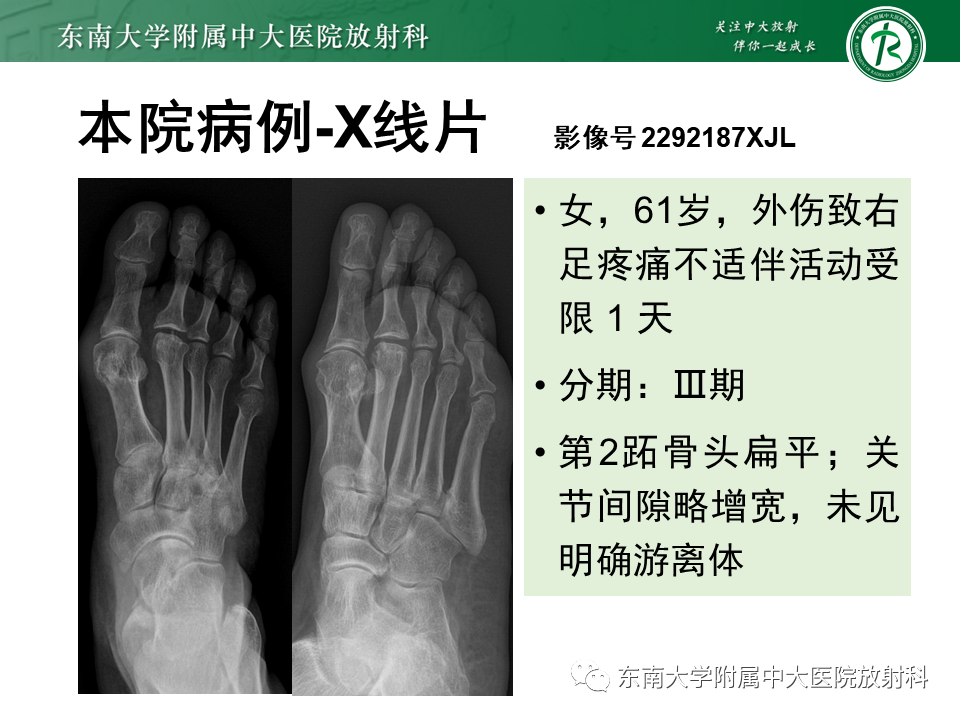 影像PPT - 【PPT】Freiberg病（跖骨头缺血性坏死）-35