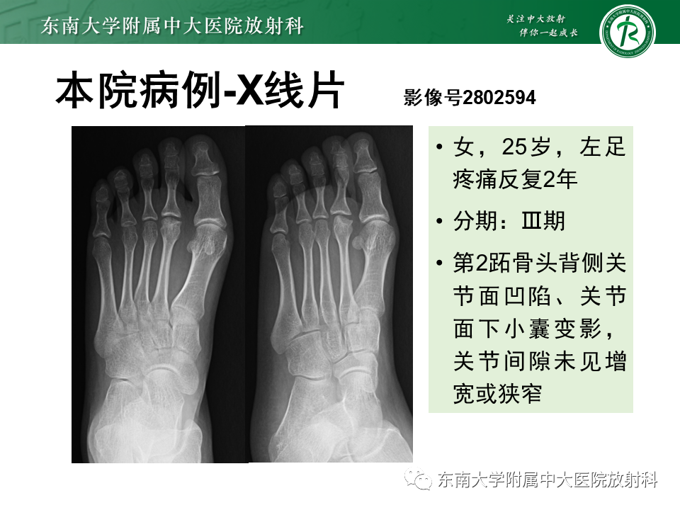 影像PPT - 【PPT】Freiberg病（跖骨头缺血性坏死）-36