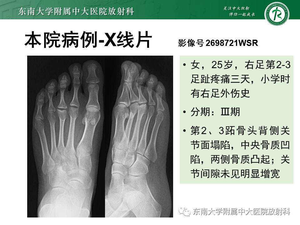 影像PPT - 【PPT】Freiberg病（跖骨头缺血性坏死）-37