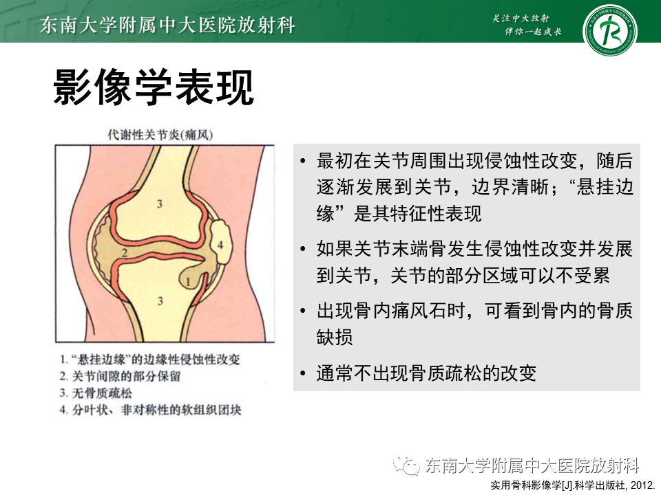 影像PPT - 【PPT】Freiberg病（跖骨头缺血性坏死）-42