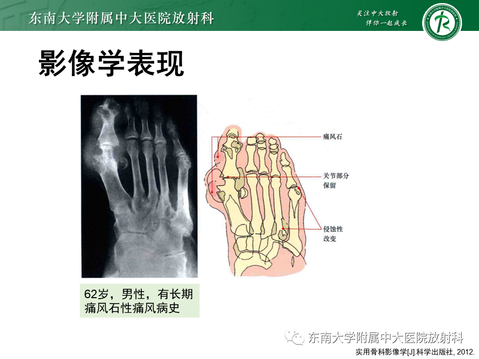 影像PPT - 【PPT】Freiberg病（跖骨头缺血性坏死）-43
