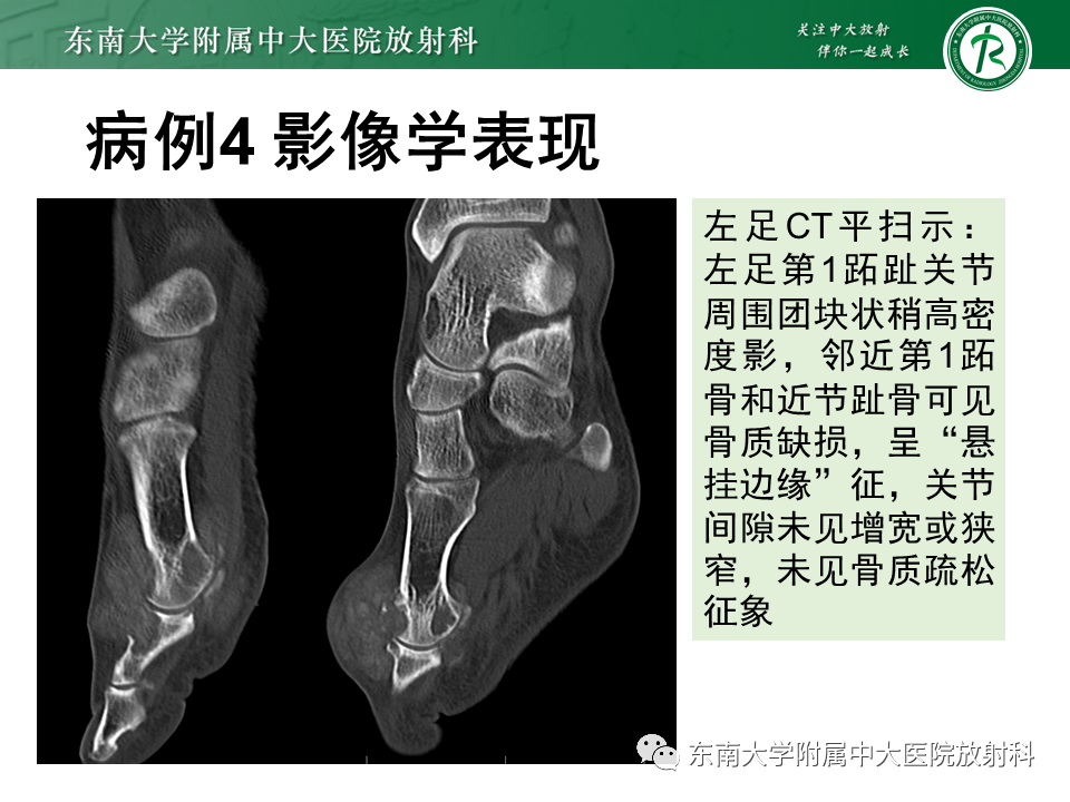 影像PPT - 【PPT】Freiberg病（跖骨头缺血性坏死）-45