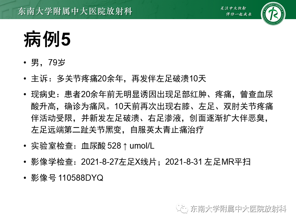 影像PPT - 【PPT】Freiberg病（跖骨头缺血性坏死）-46