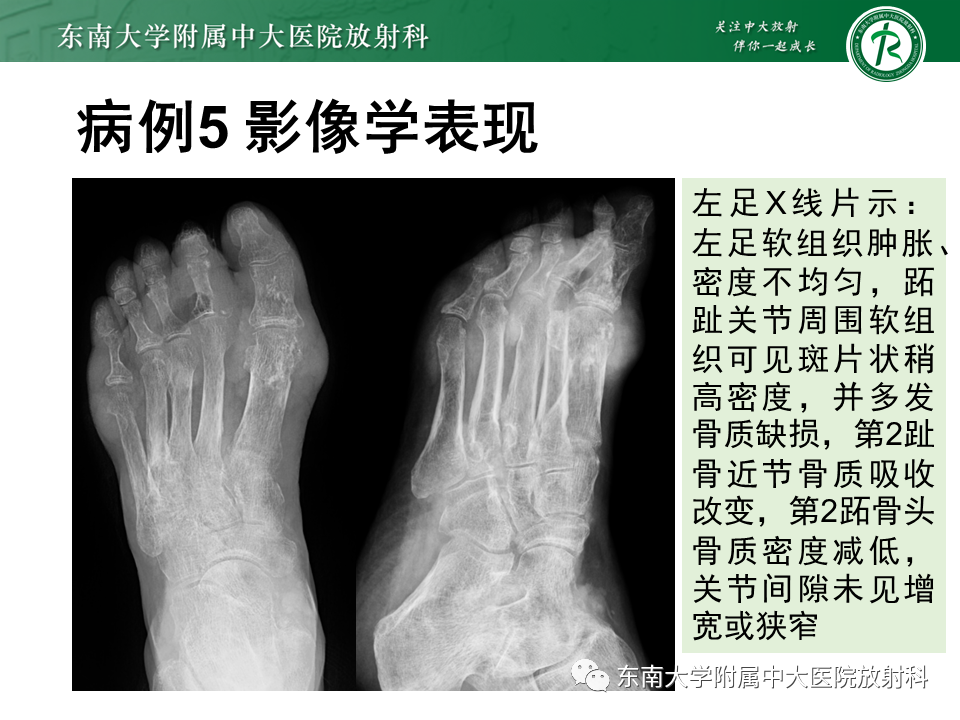 影像PPT - 【PPT】Freiberg病（跖骨头缺血性坏死）-47