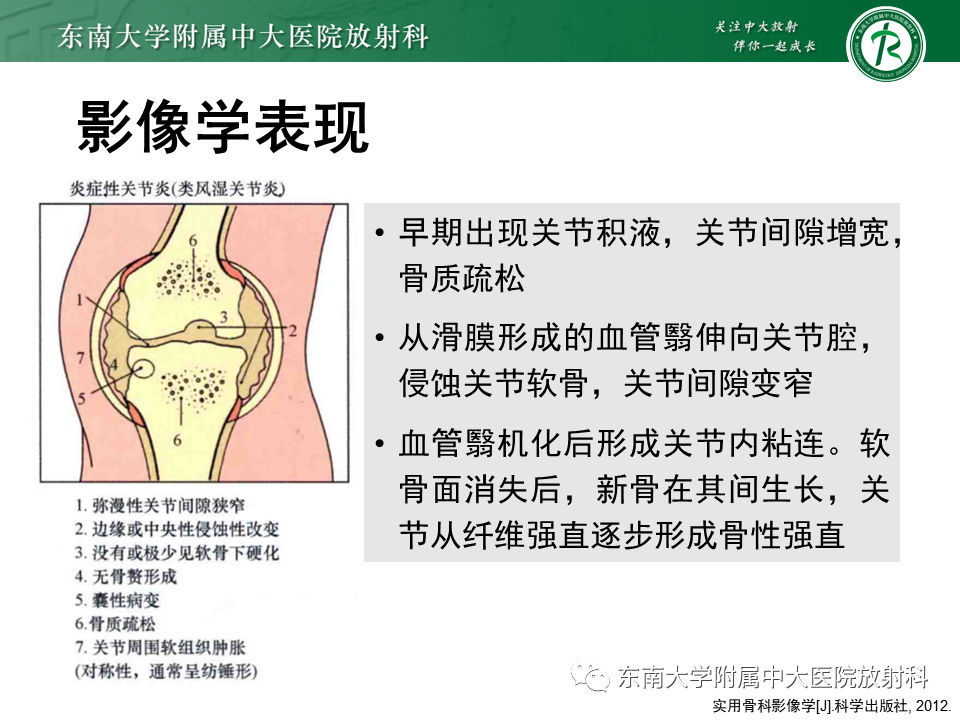 影像PPT - 【PPT】Freiberg病（跖骨头缺血性坏死）-50