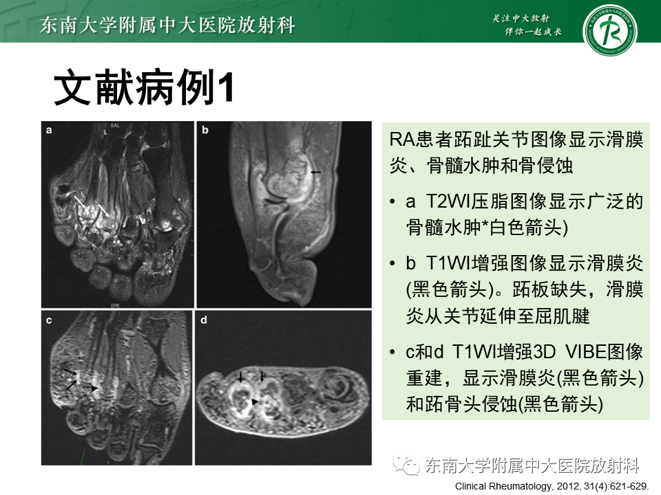 影像PPT - 【PPT】Freiberg病（跖骨头缺血性坏死）-52
