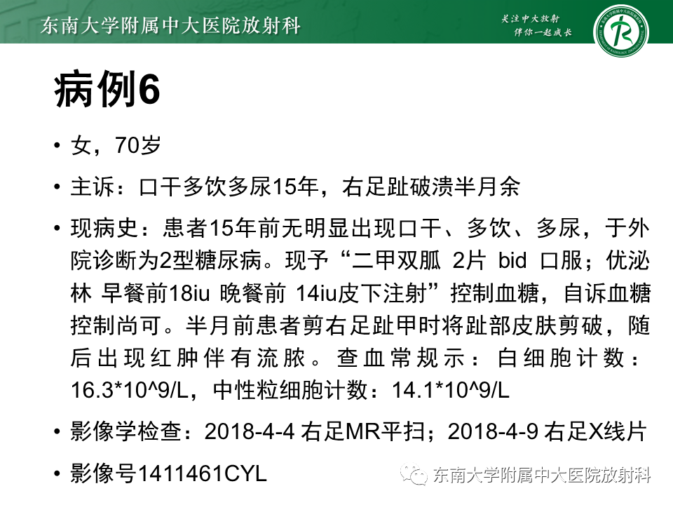 影像PPT - 【PPT】Freiberg病（跖骨头缺血性坏死）-56