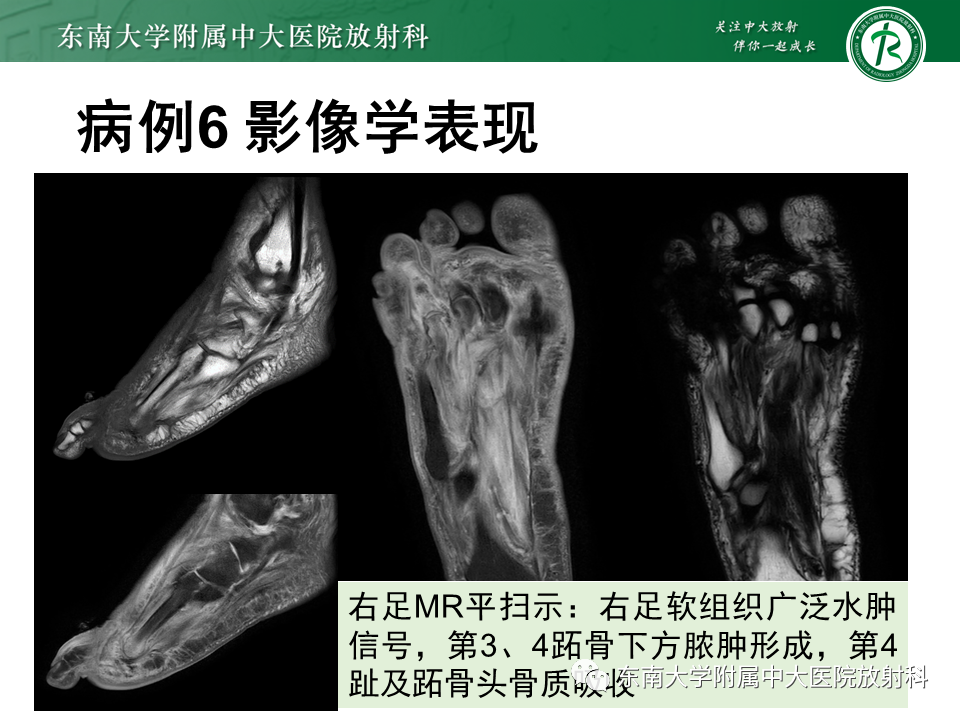 影像PPT - 【PPT】Freiberg病（跖骨头缺血性坏死）-57
