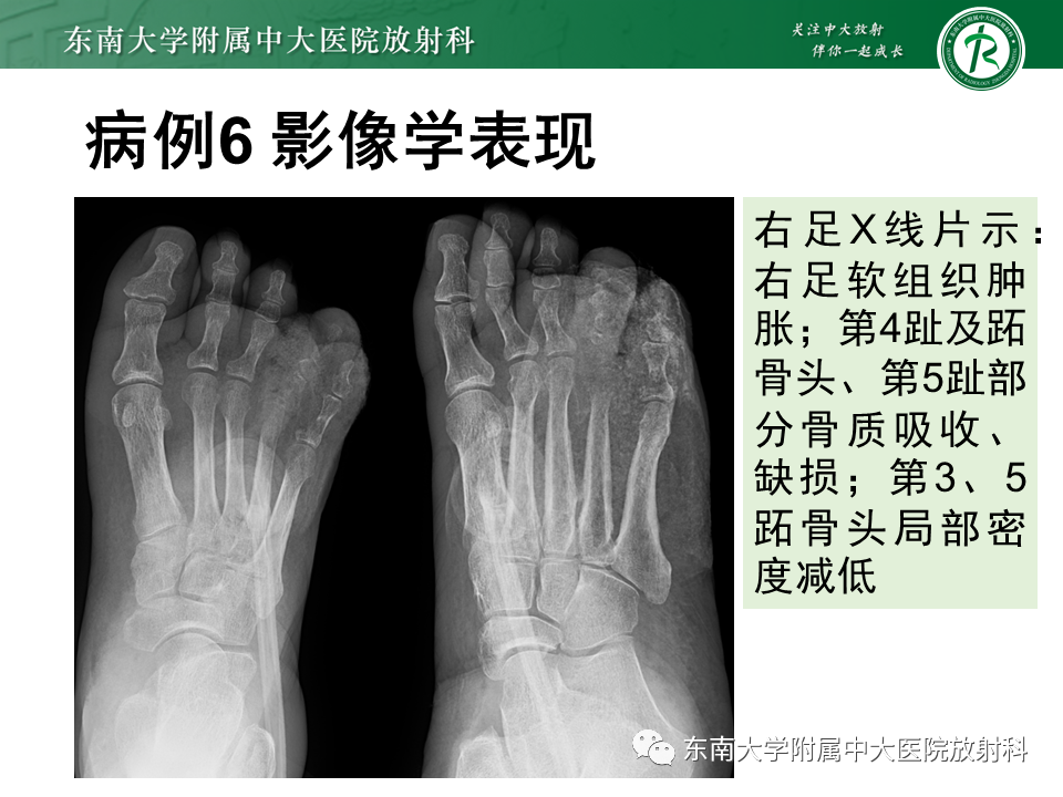 影像PPT - 【PPT】Freiberg病（跖骨头缺血性坏死）-58
