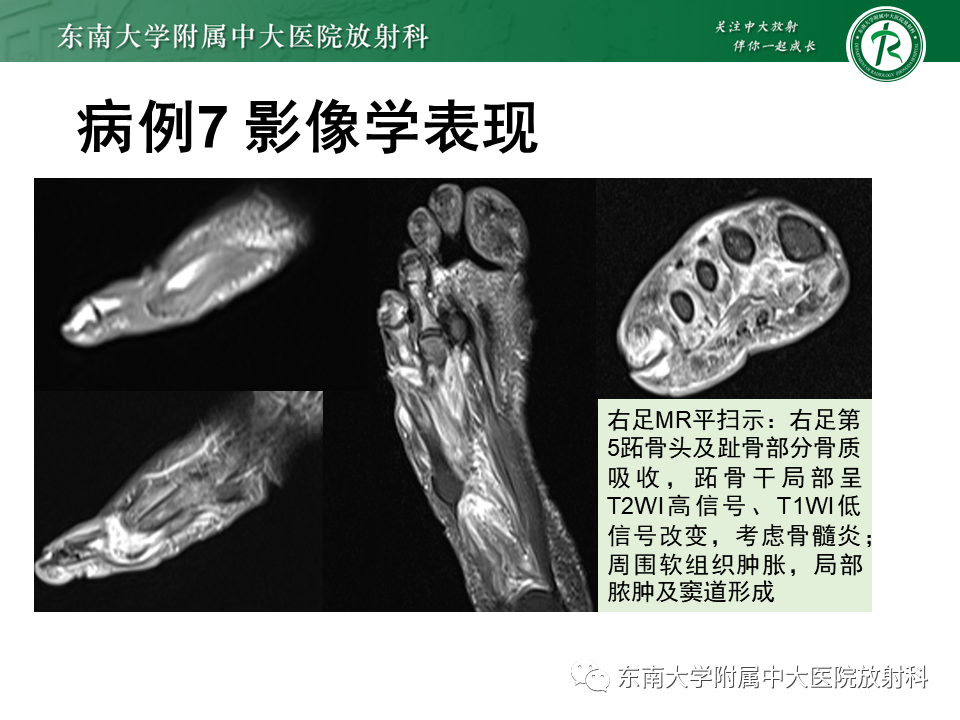 影像PPT - 【PPT】Freiberg病（跖骨头缺血性坏死）-60