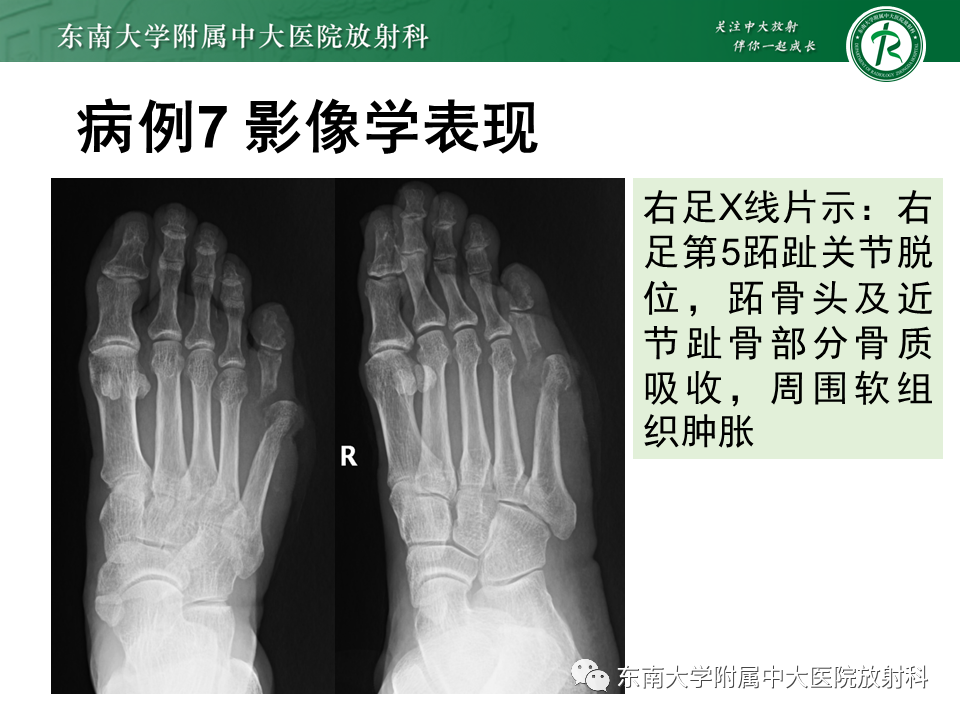 影像PPT - 【PPT】Freiberg病（跖骨头缺血性坏死）-61