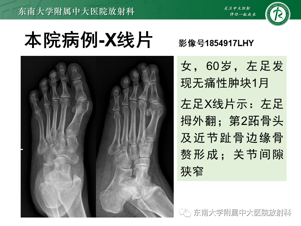 影像PPT - 【PPT】Freiberg病（跖骨头缺血性坏死）-64