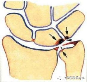 影像PPT - 尺骨撞击综合征影像表现-1 影像PPT - 尺骨撞击综合征影像表现-1