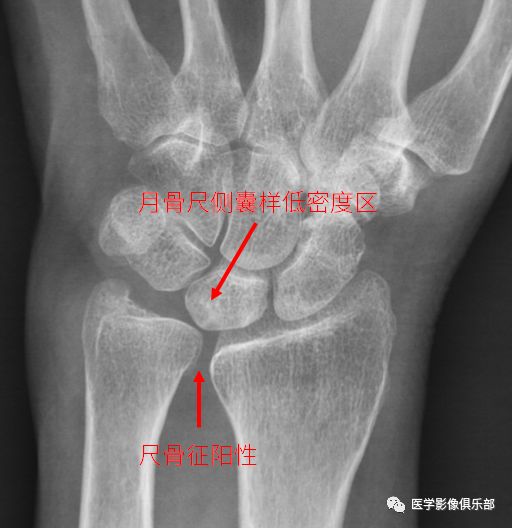 影像PPT - 尺骨撞击综合征影像表现-6 影像PPT - 尺骨撞击综合征影像表现-6