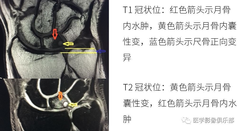 影像PPT - 尺骨撞击综合征影像表现-7 影像PPT - 尺骨撞击综合征影像表现-7
