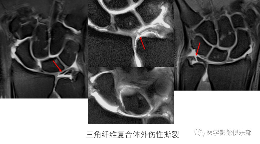 影像PPT - 尺骨撞击综合征影像表现-8 影像PPT - 尺骨撞击综合征影像表现-8