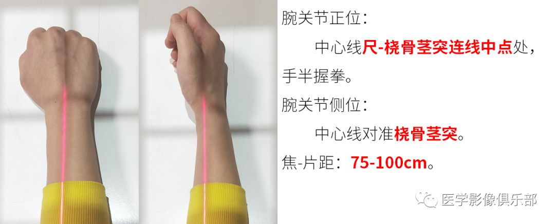 影像PPT - 尺骨撞击综合征影像表现-9 影像PPT - 尺骨撞击综合征影像表现-9