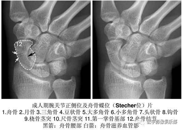 影像PPT - 尺骨撞击综合征影像表现-12 影像PPT - 尺骨撞击综合征影像表现-12