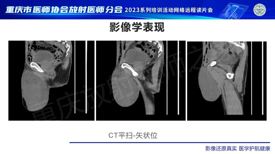 影像PPT - 【病例】腹股沟区横纹肌肉瘤1例CT影像-5