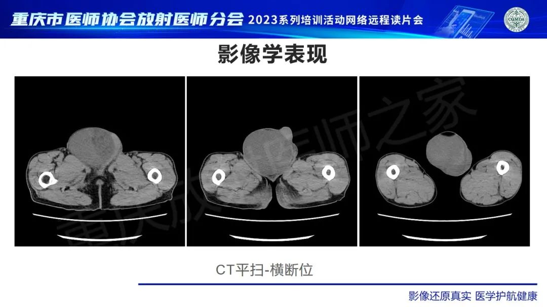 影像PPT - 【病例】腹股沟区横纹肌肉瘤1例CT影像-4