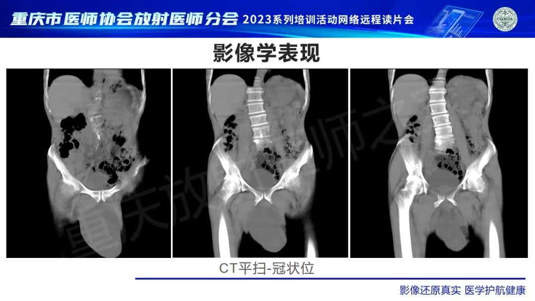 影像PPT - 【病例】腹股沟区横纹肌肉瘤1例CT影像-6