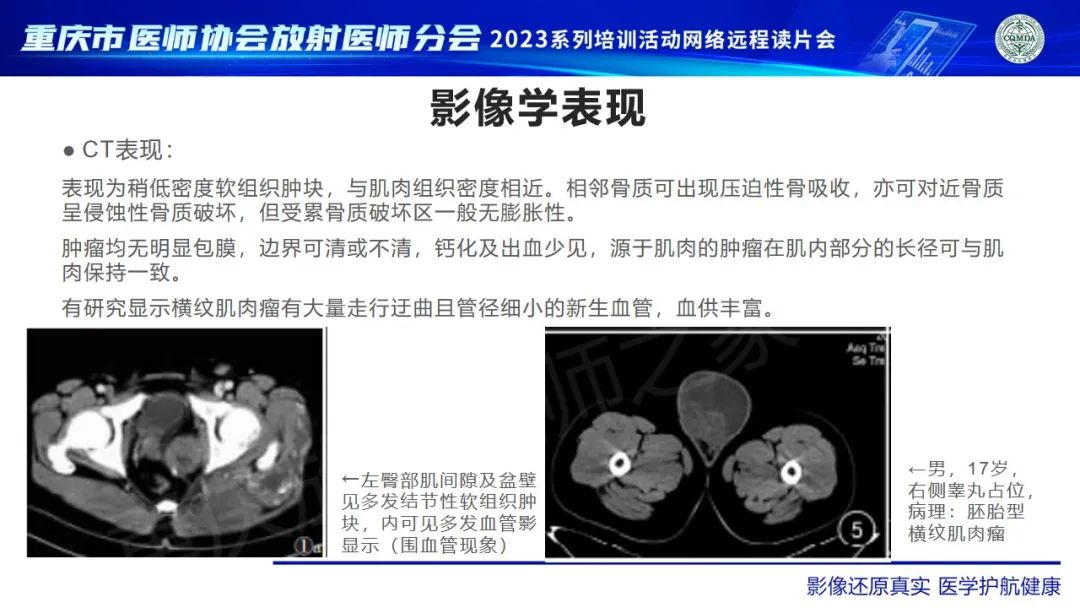 影像PPT - 【病例】腹股沟区横纹肌肉瘤1例CT影像-10