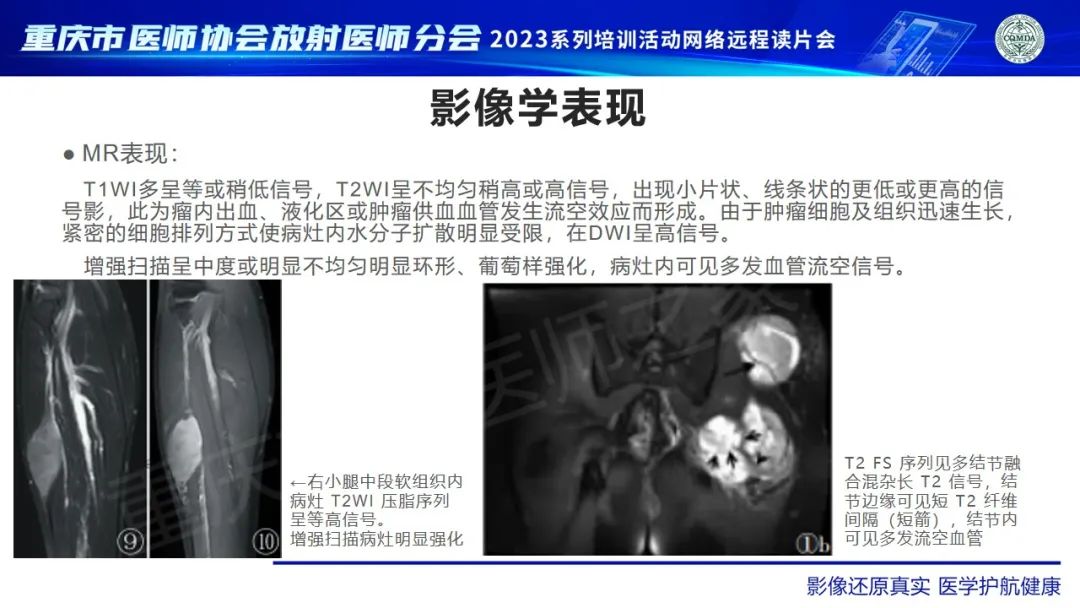 影像PPT - 【病例】腹股沟区横纹肌肉瘤1例CT影像-11