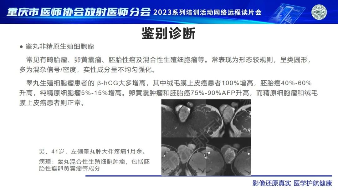 影像PPT - 【病例】腹股沟区横纹肌肉瘤1例CT影像-13