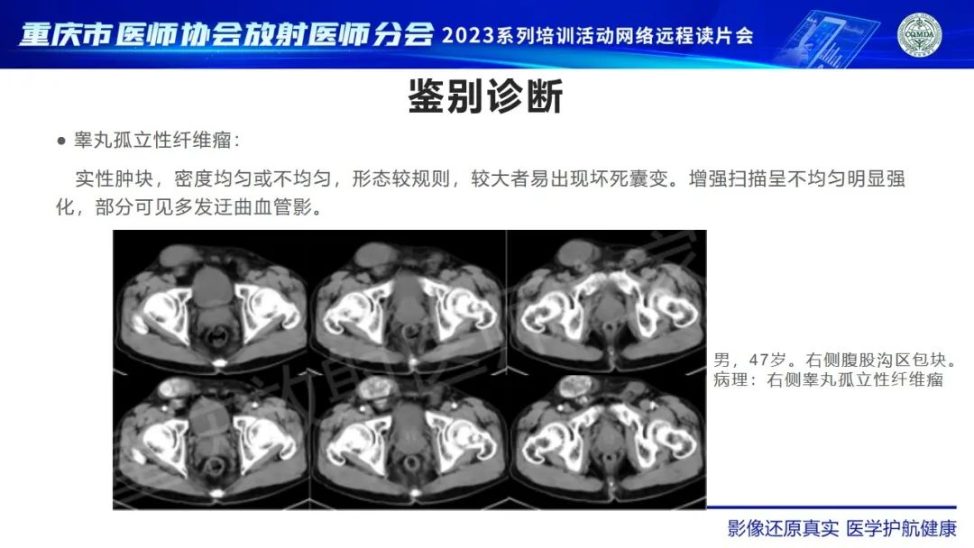 影像PPT - 【病例】腹股沟区横纹肌肉瘤1例CT影像-14