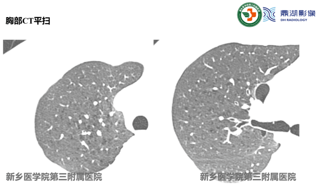 影像PPT - 【病例】肺淋巴管肌瘤病(结节性硬化)1例CT影像-7