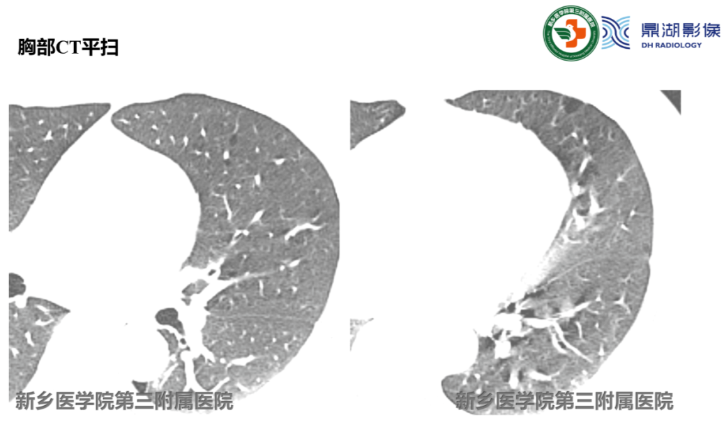 影像PPT - 【病例】肺淋巴管肌瘤病(结节性硬化)1例CT影像-10