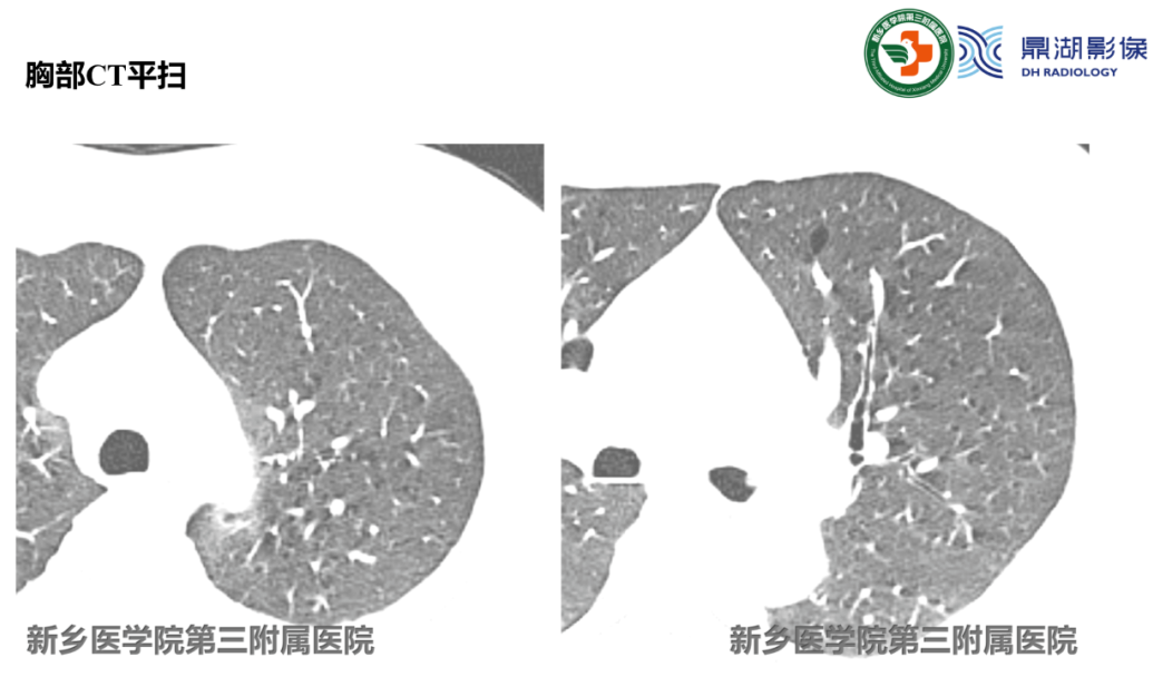 影像PPT - 【病例】肺淋巴管肌瘤病(结节性硬化)1例CT影像-9