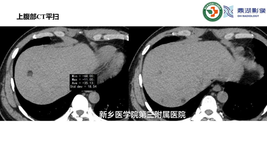 影像PPT - 【病例】肺淋巴管肌瘤病(结节性硬化)1例CT影像-12