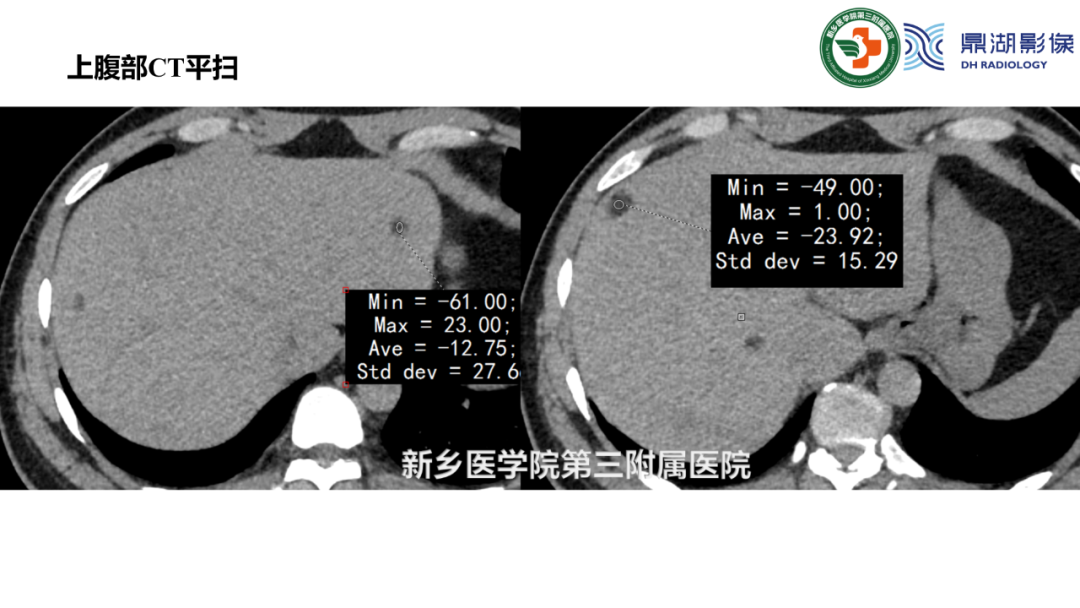 影像PPT - 【病例】肺淋巴管肌瘤病(结节性硬化)1例CT影像-13
