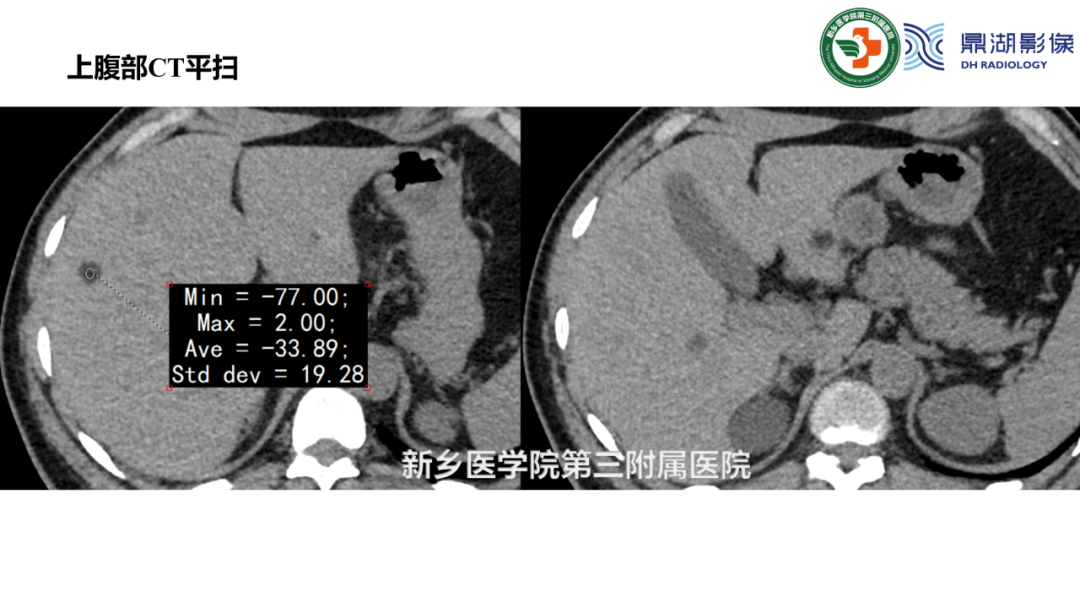 影像PPT - 【病例】肺淋巴管肌瘤病(结节性硬化)1例CT影像-14