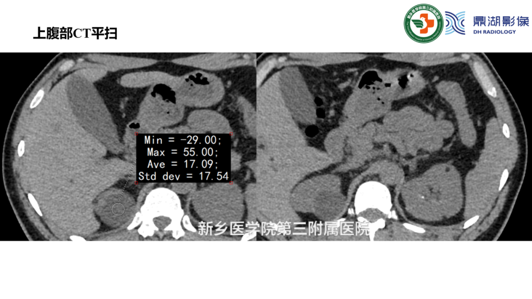 影像PPT - 【病例】肺淋巴管肌瘤病(结节性硬化)1例CT影像-15