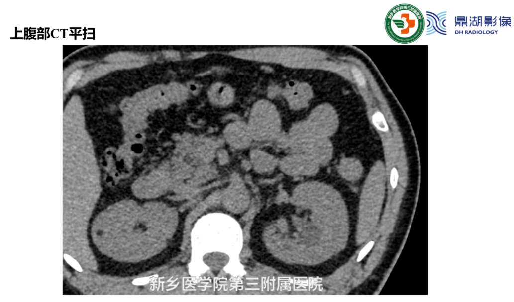 影像PPT - 【病例】肺淋巴管肌瘤病(结节性硬化)1例CT影像-16