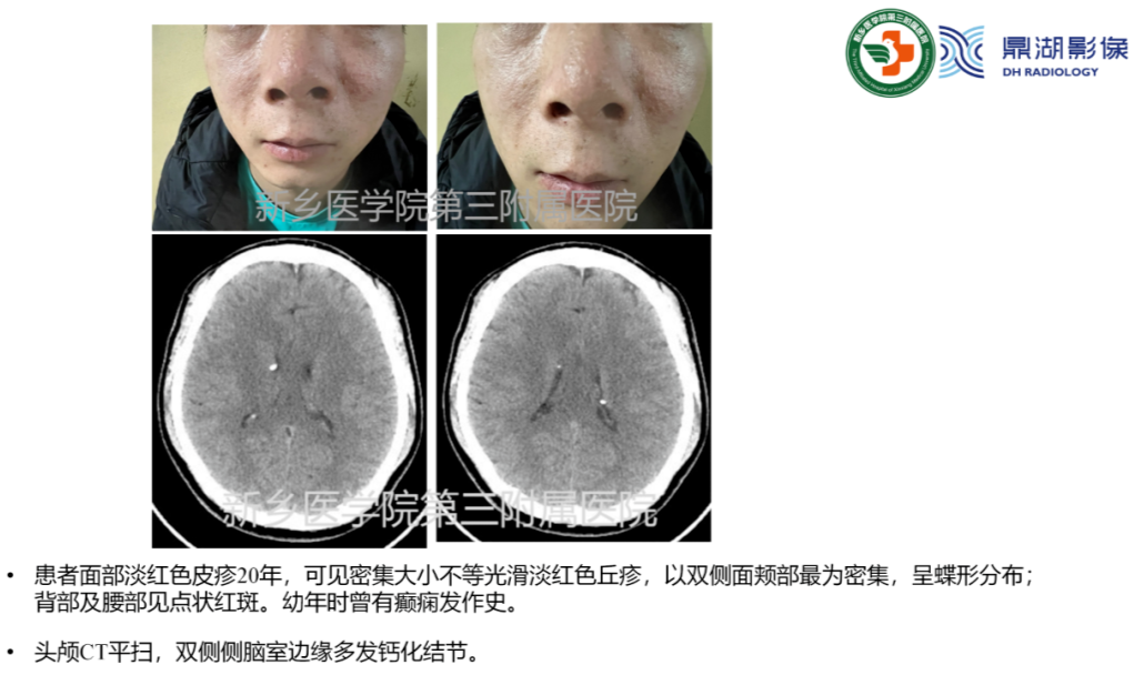 影像PPT - 【病例】肺淋巴管肌瘤病(结节性硬化)1例CT影像-18