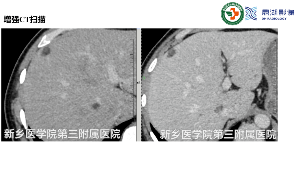 影像PPT - 【病例】肺淋巴管肌瘤病(结节性硬化)1例CT影像-21