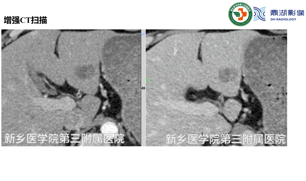 影像PPT - 【病例】肺淋巴管肌瘤病(结节性硬化)1例CT影像-22