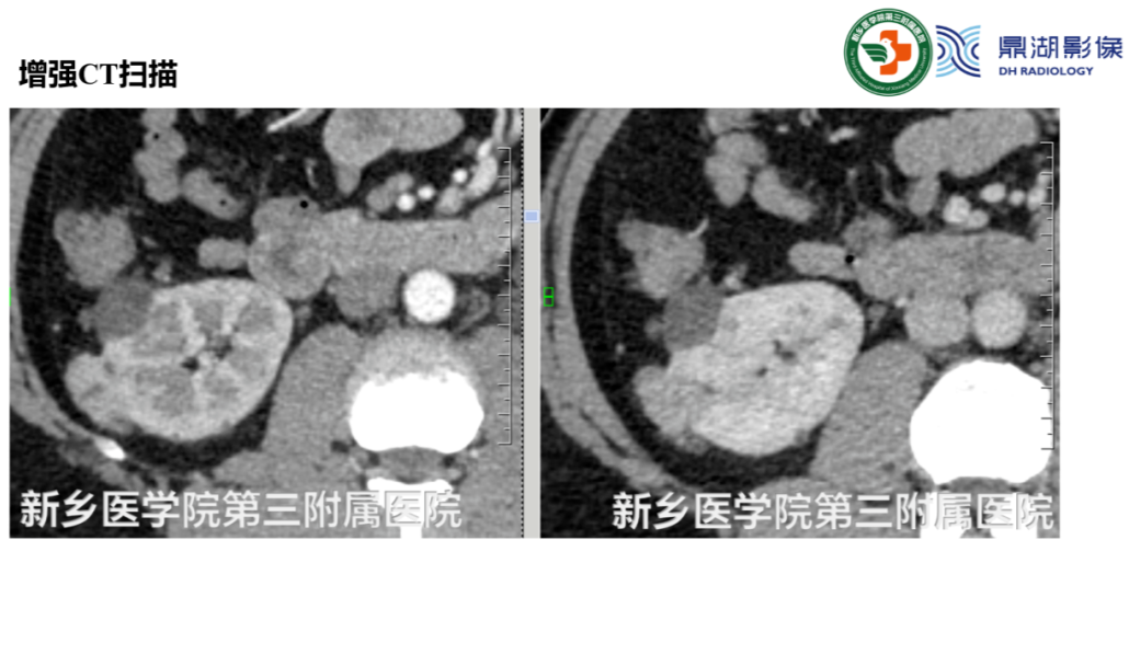 影像PPT - 【病例】肺淋巴管肌瘤病(结节性硬化)1例CT影像-25