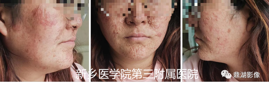 影像PPT - 【病例】肺淋巴管肌瘤病(结节性硬化)1例CT影像-38