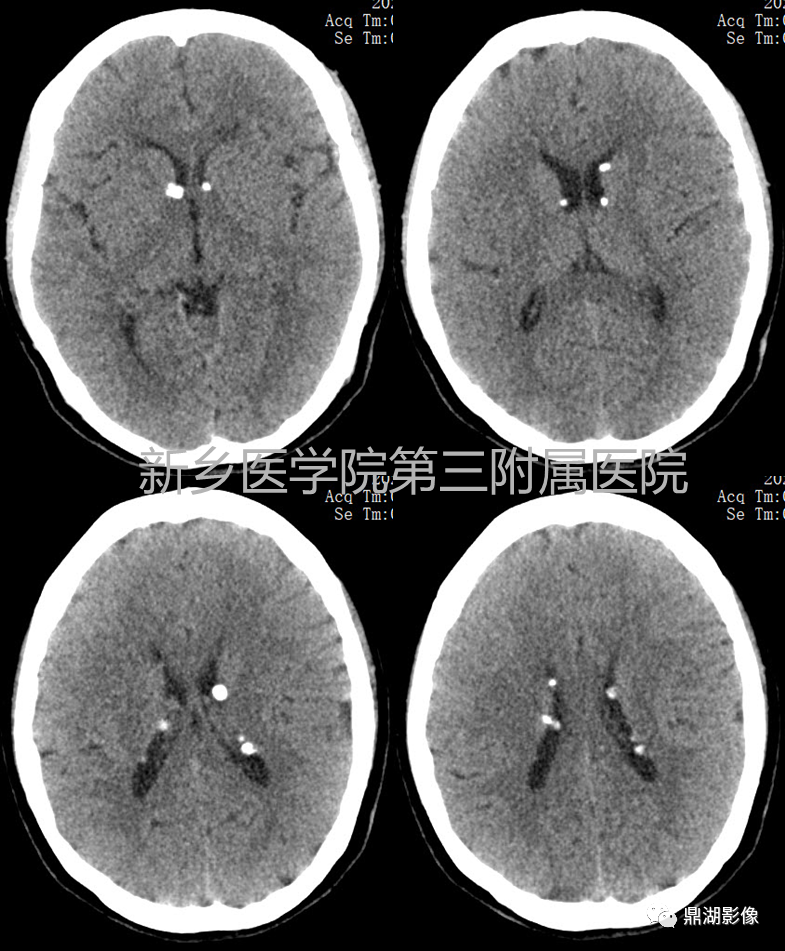 影像PPT - 【病例】肺淋巴管肌瘤病(结节性硬化)1例CT影像-40
