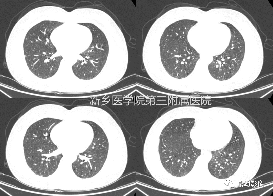 影像PPT - 【病例】肺淋巴管肌瘤病(结节性硬化)1例CT影像-41