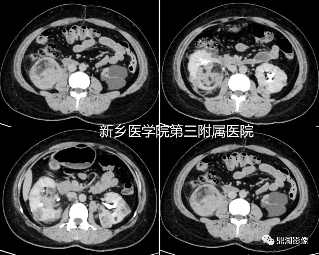 影像PPT - 【病例】肺淋巴管肌瘤病(结节性硬化)1例CT影像-42