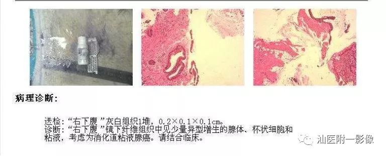 影像PPT - 【病例】阑尾粘液腺癌1例CT影像-10