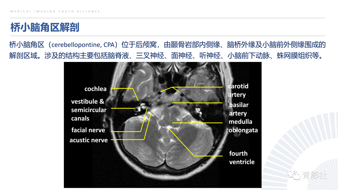 影像PPT - 【PPT】桥小脑角区肿瘤的影像诊断-3
